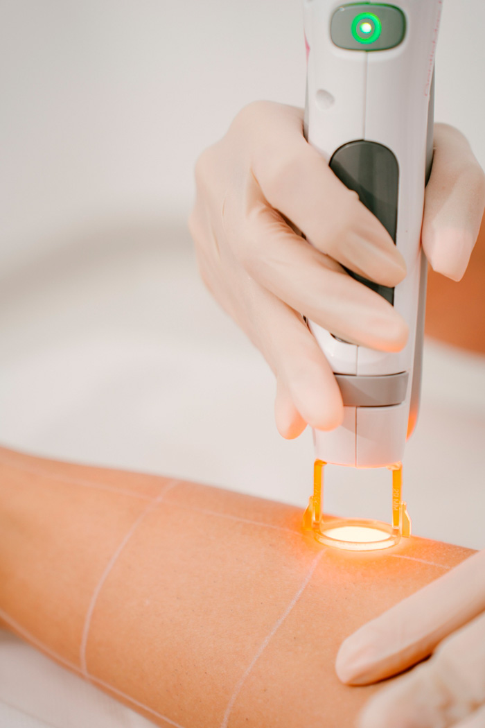 depiderme-depilacao-laser-processo3